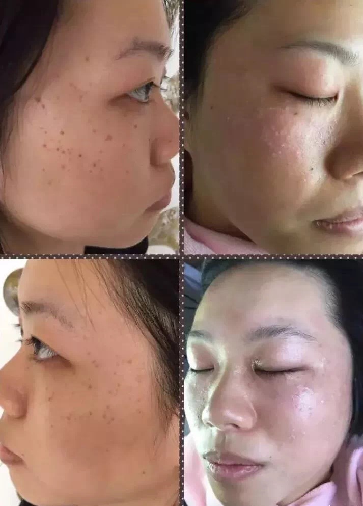 扁平疣的五种不同类型