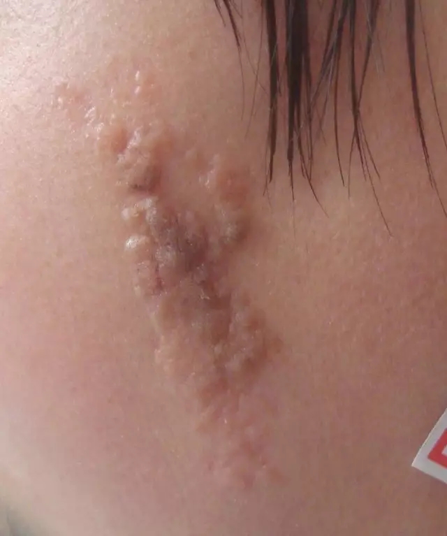 "皮脂腺痣"容易和哪些病症混瑶?