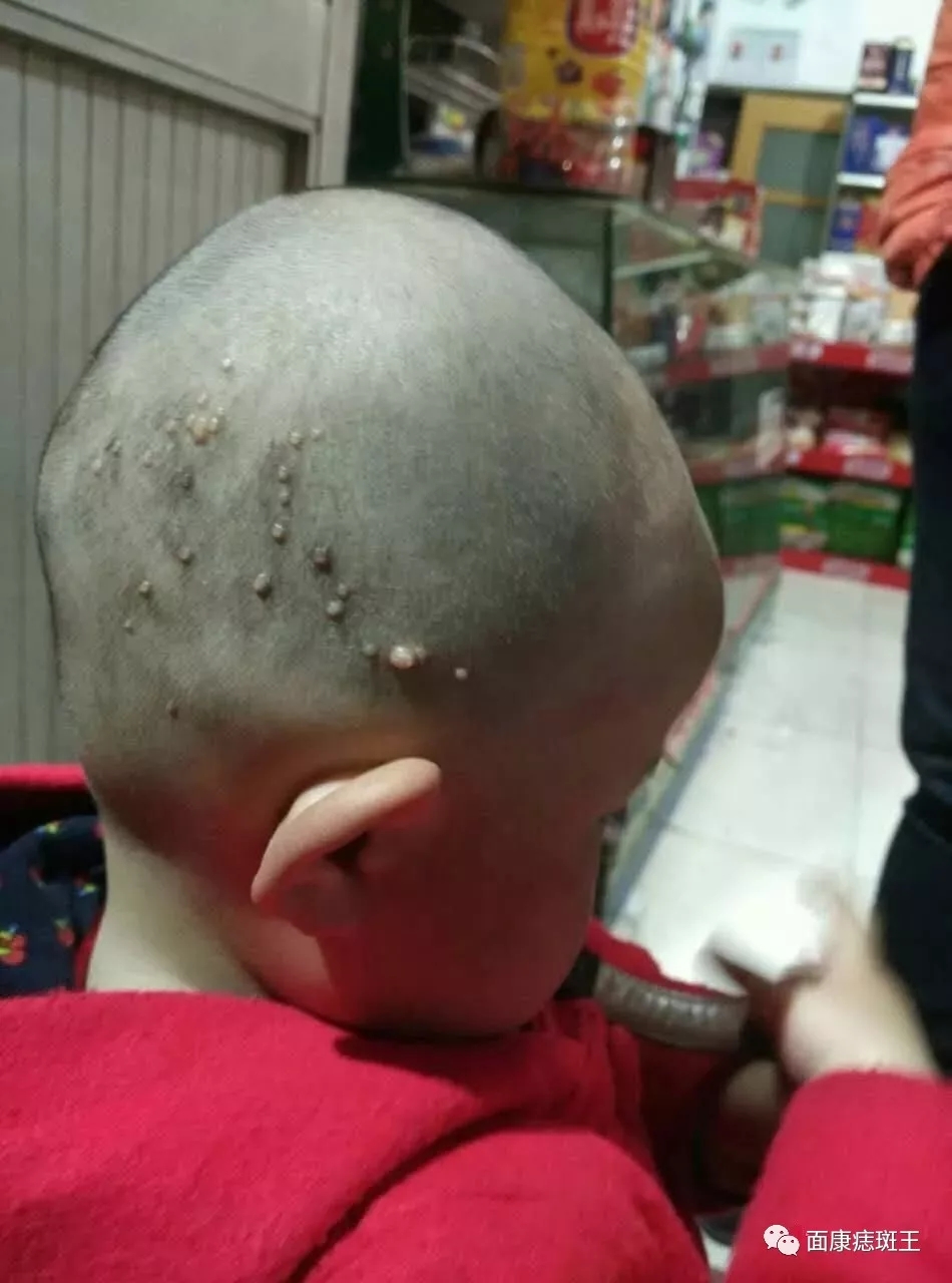 疣以寻常疣较为多见有哪些症状