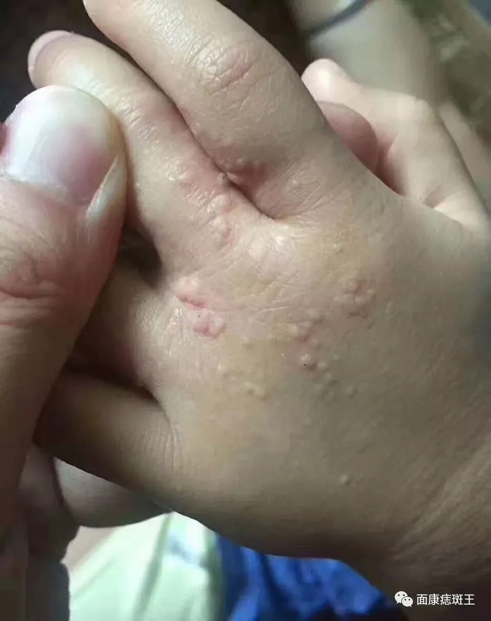 如何正确认识扁平疣